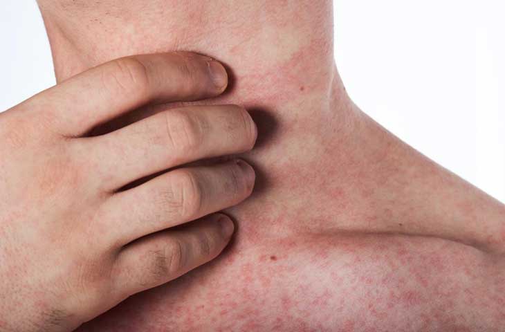 Sốt xuất huyết