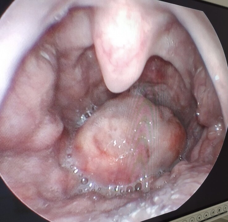 viem nap thanh nhiet