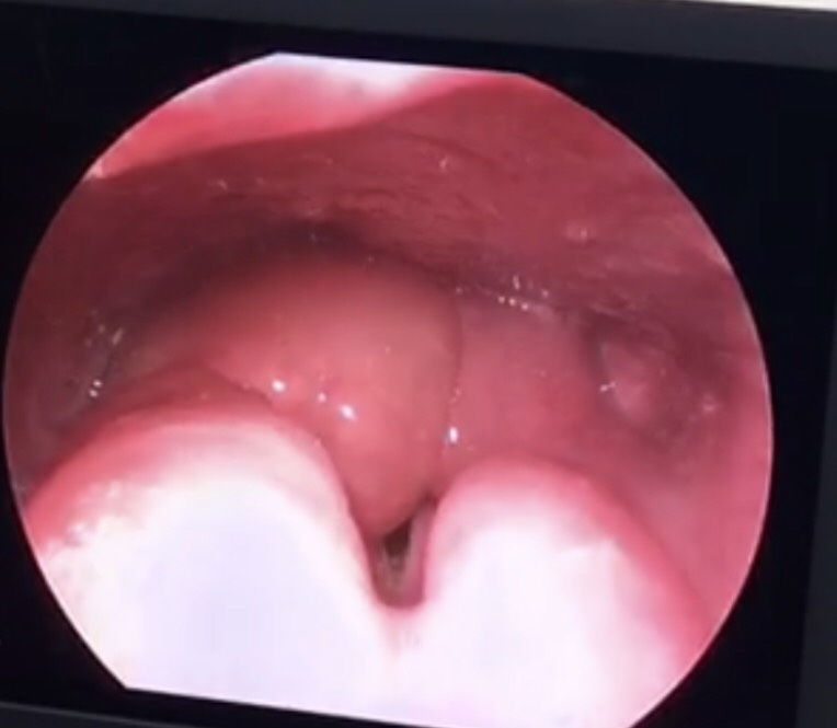 viem nap thanh nhiet