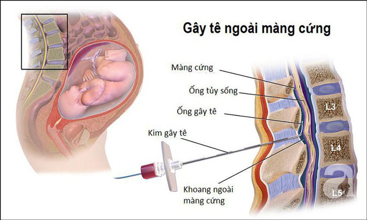 gây tê ngoài màng cứng
