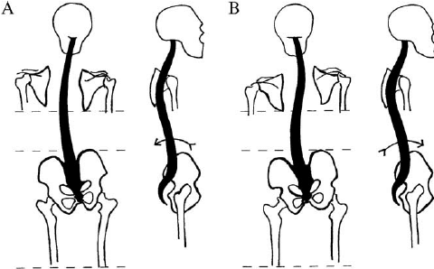 lệch khớp xương chậu