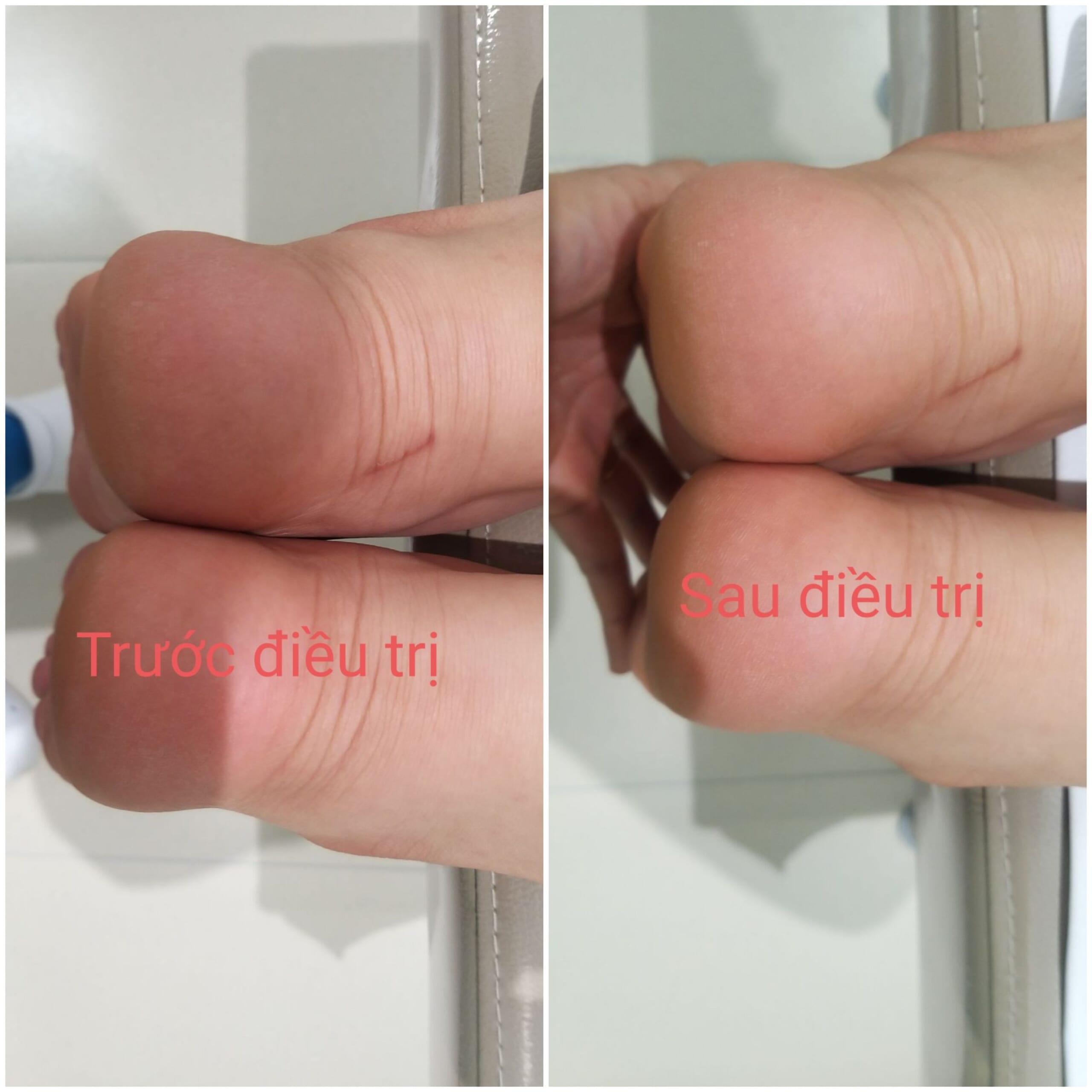 lech khop xuong chau