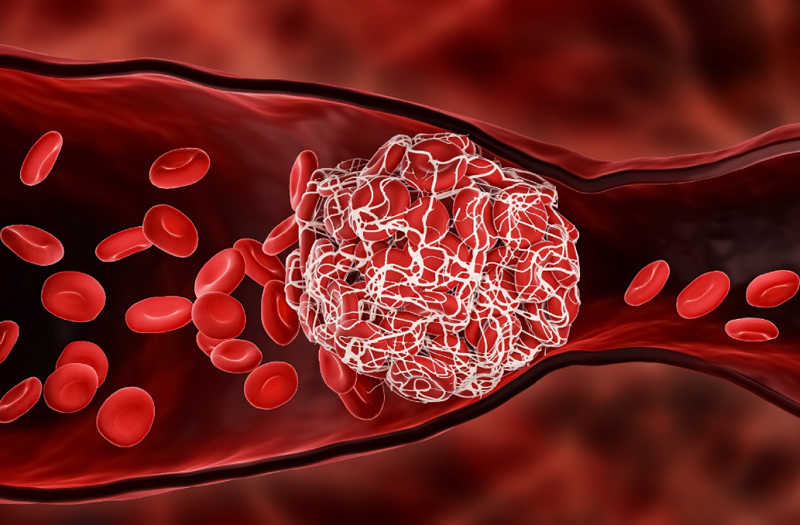 Cảnh báo nguy cơ đột quỵ do rối loạn đông máu hậu COVID-19