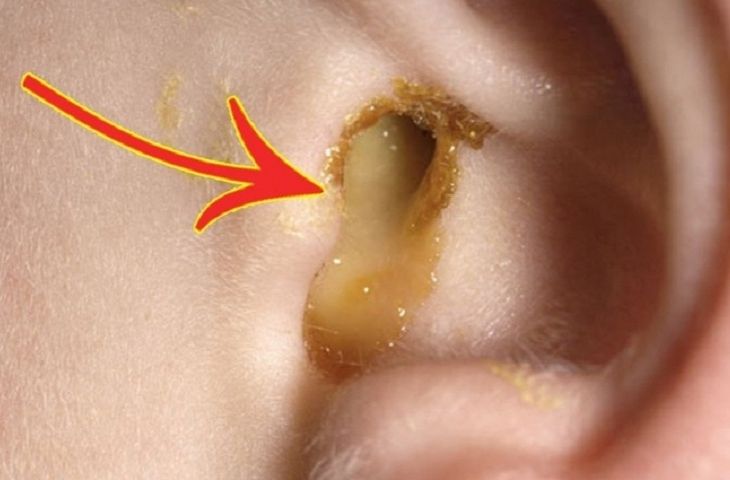 9 triệu chứng cảnh báo bé bị viêm tai giữa mà cha mẹ cần lưu tâm 