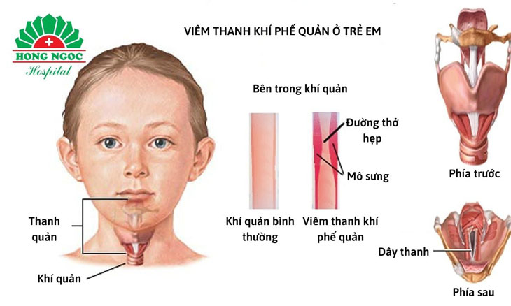 trẻ bị viêm thanh khí phế quản 