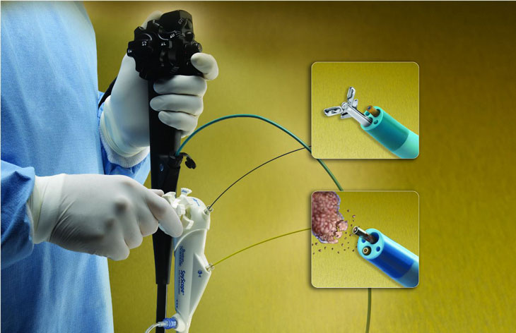 phương pháp điều trị sỏi niệu quản