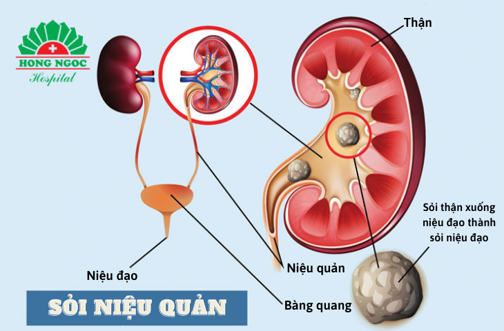 Sỏi niệu quản khi mang thai