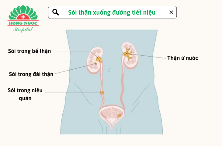 sỏi thận xuống đường tiết niệu