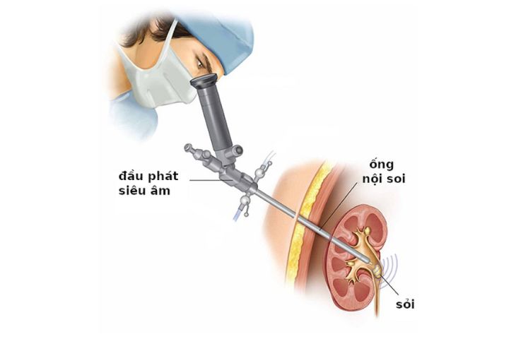 chi phí phẫu thuật nội soi sỏi thận