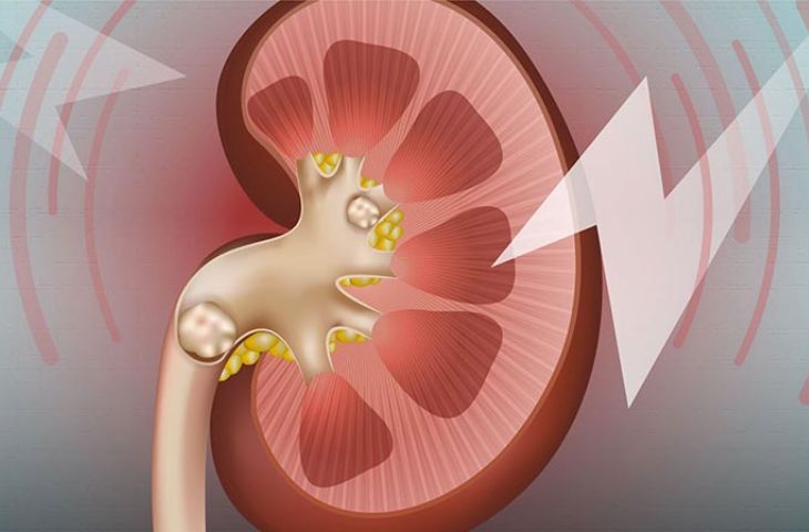 chi phí phẫu thuật nội soi sỏi thận