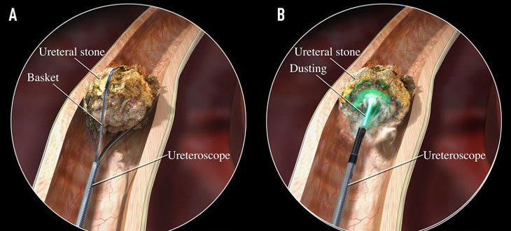 chi phí tán sỏi bằng laser