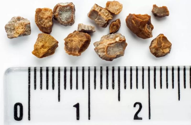 điều trị sỏi thận 8mm