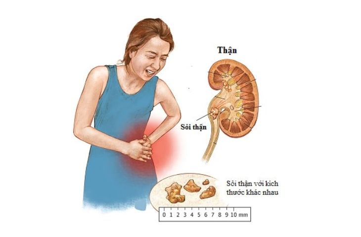 điều trị sỏi thận 8mm