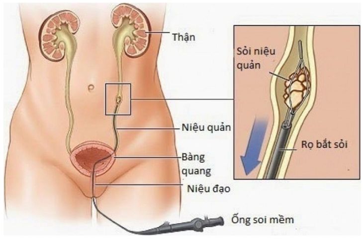 phẫu thuật sỏi thận