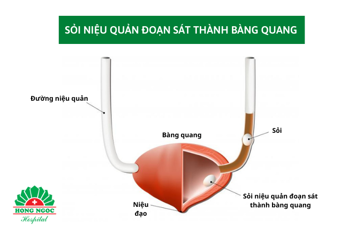 sỏi niệu quản đoạn sát thành bàng quang 