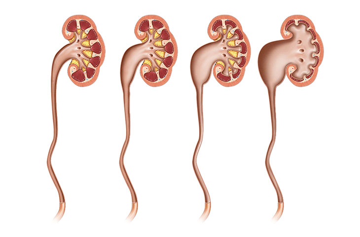 sỏi niệu quản đoạn sát thành bàng quang