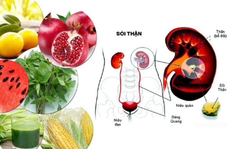 sỏi thận nên kiêng gì