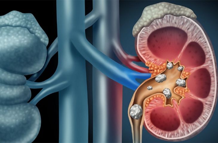 sỏi thận rơi xuống bàng quang
