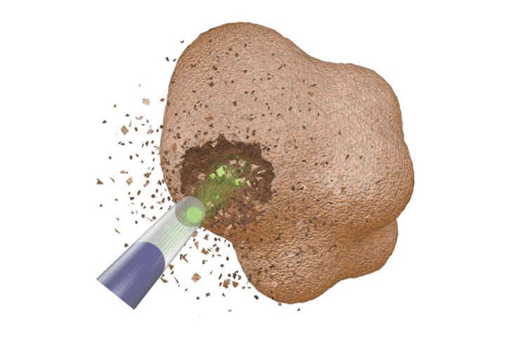 sỏi thận rơi xuống bàng quang