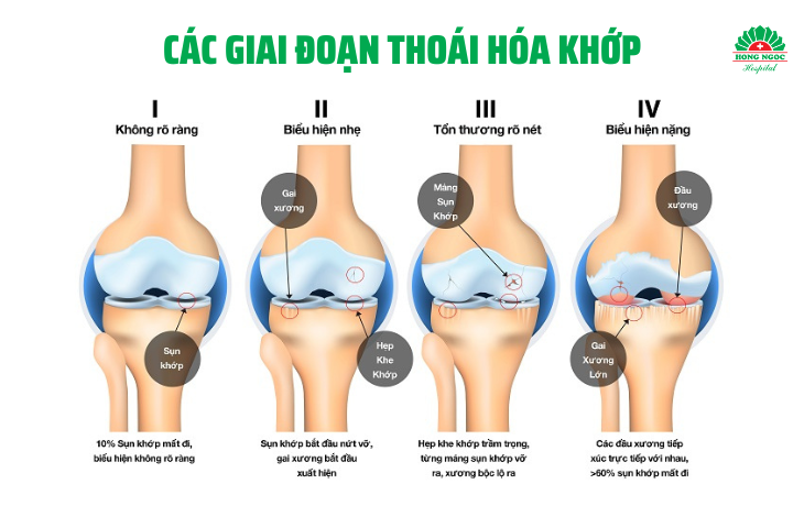 điều trị thoái hóa khớp