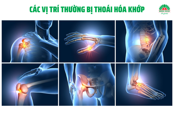 điều trị thoái hóa khớp