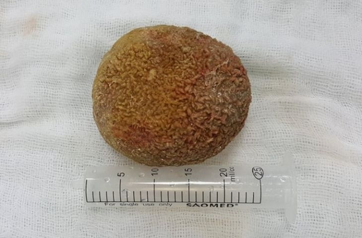 kích thước sỏi niệu quản