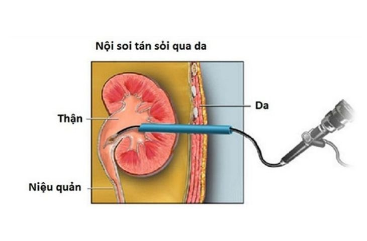 quy trình tán sỏi qua da