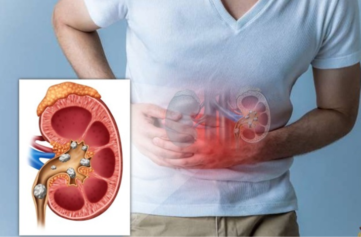 kích thước sỏi thận