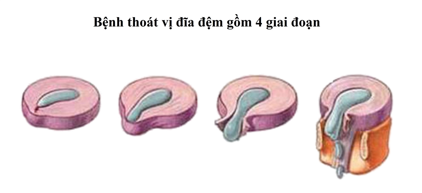 các giai đoạn thoát vị đĩa đệm