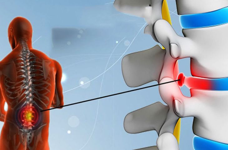 bệnh phồng đĩa đệm