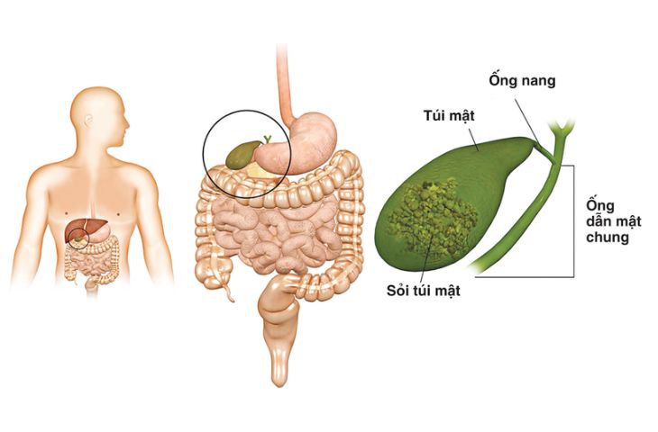 tán sỏi mật qua da