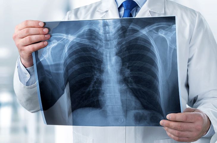 Thoát vị đĩa đệm