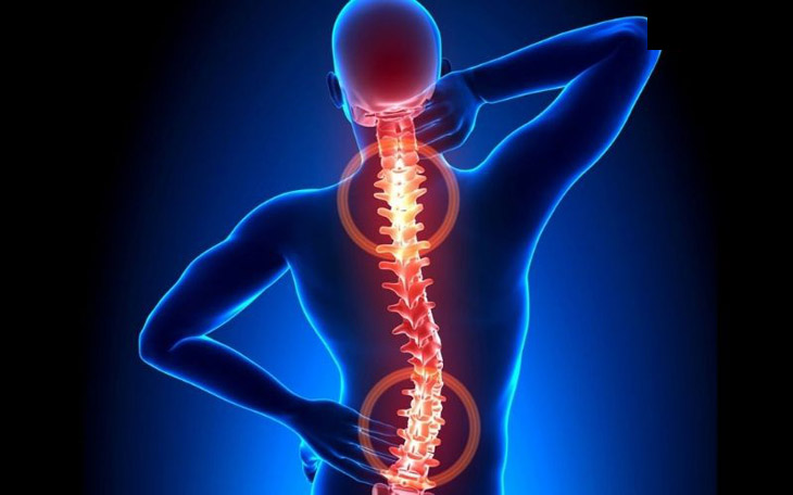 Thoát vị đĩa đệm cột sống đa là tình trạng nghiêm trọng