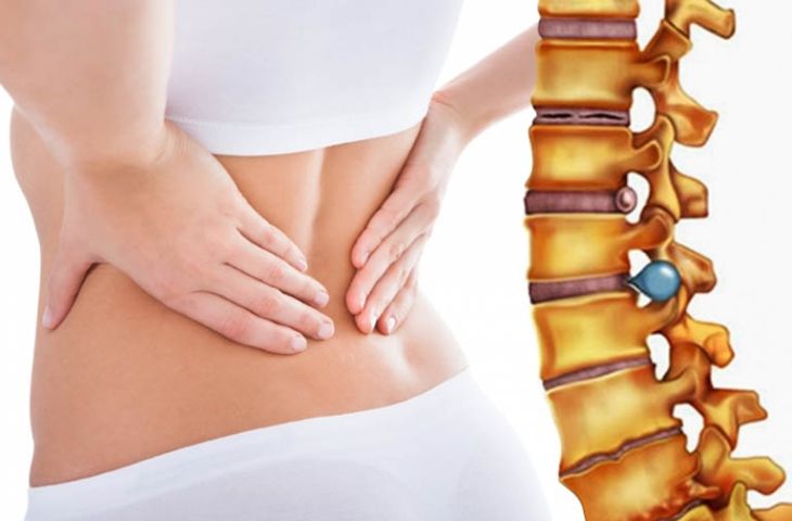 Triệu chứng thoát vị đĩa đệm