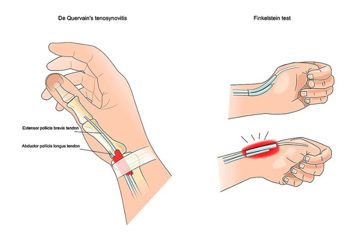 hội chứng de-quervain