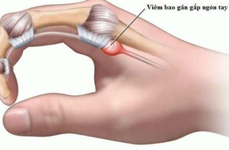 bệnh viêm bao gân có nguy hiểm không