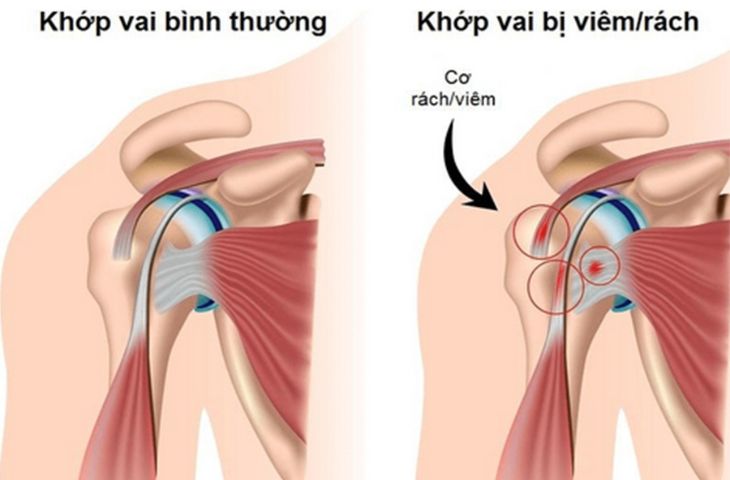 viêm quanh khớp vai