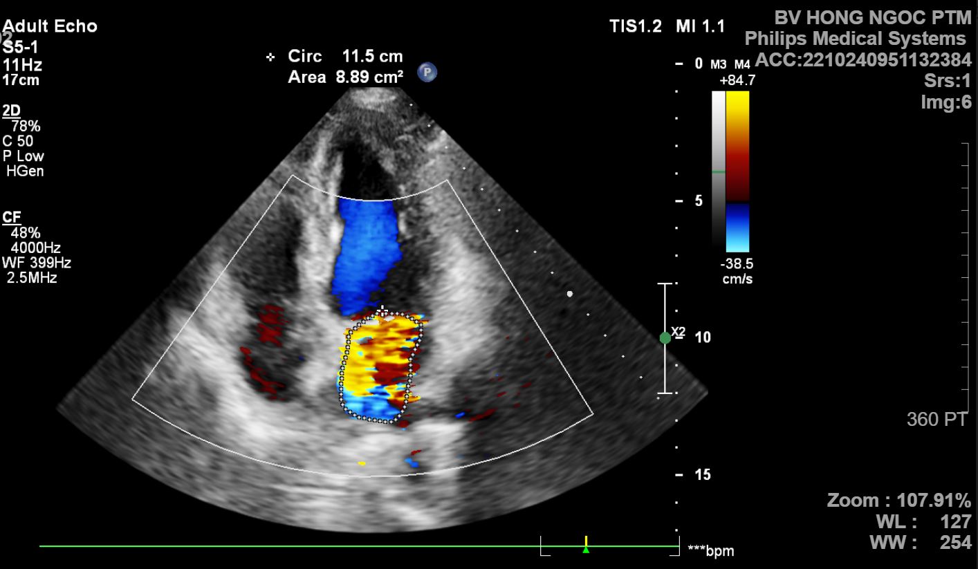 hình ảnh siêu âm bệnh lý cấu trúc tim