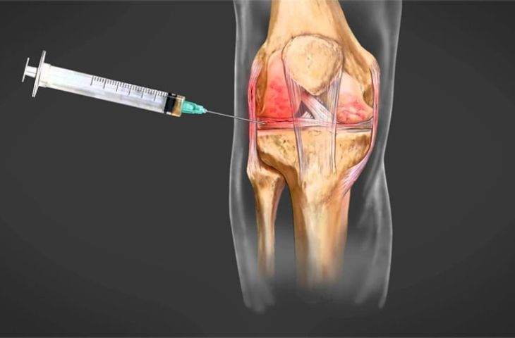 Tiêm PRP có tác dụng gì?