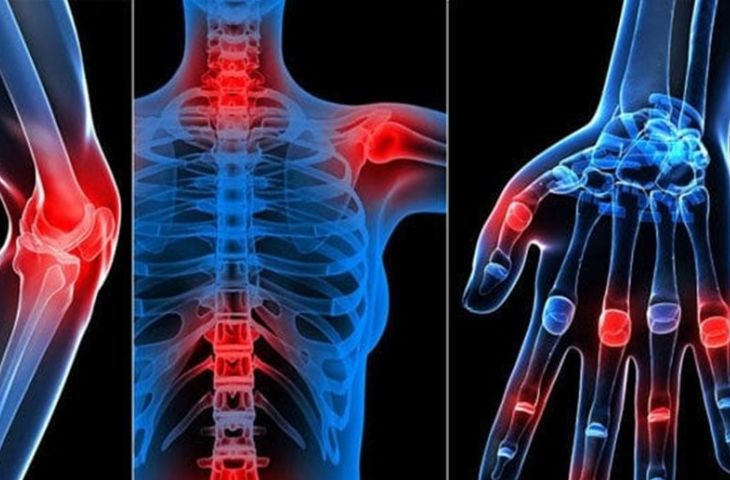 Dấu hiệu viêm khớp dạng thấp