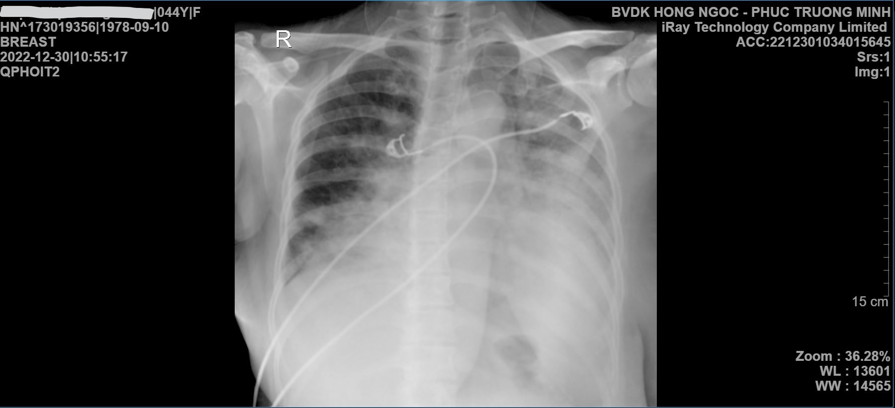 Chụp Xquang phổi