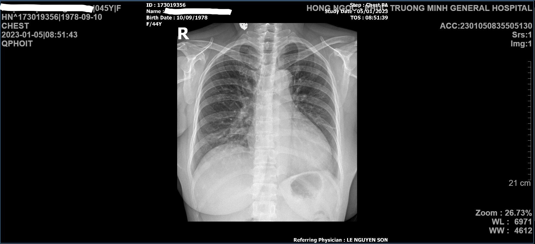 Chụp Xquang phổi