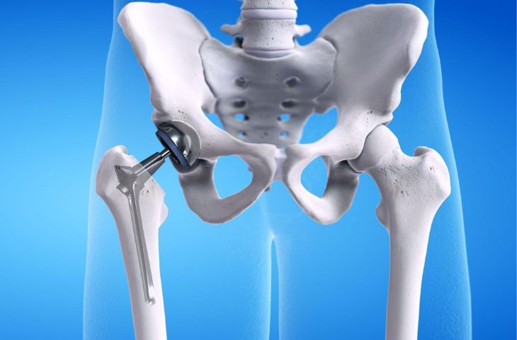 điều trị thoái hóa khớp háng