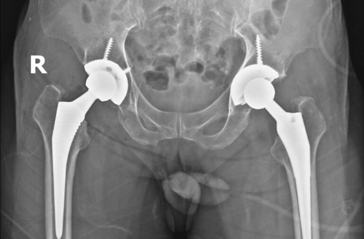 điều trị thoái hóa khớp háng