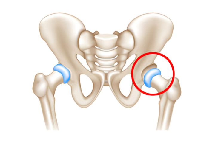 nguyên nhân thoái hóa khớp háng