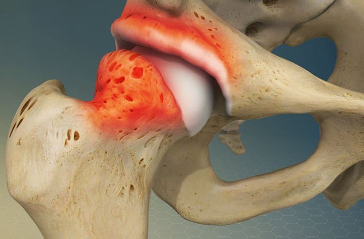 triệu chứng thoái hóa khớp háng