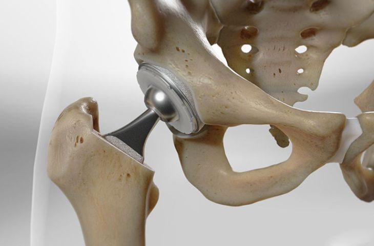 triệu chứng thoái hóa khớp háng