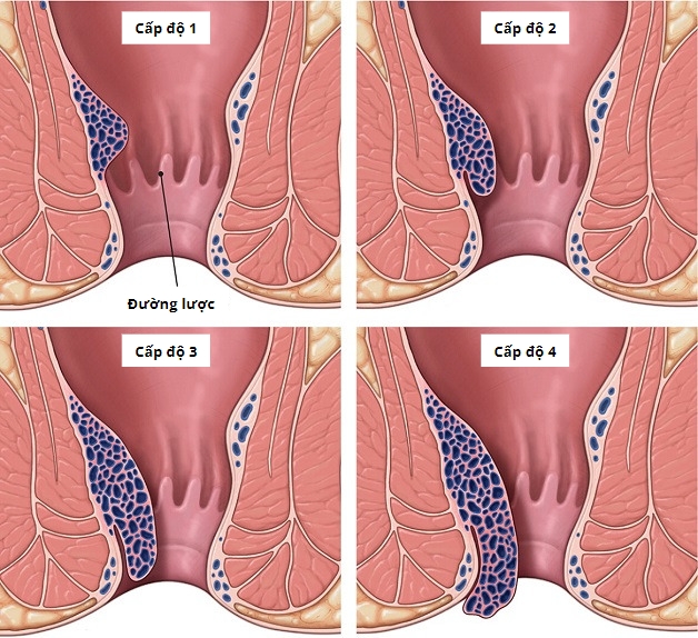 Phân độ trĩ nội theo các cấp độ