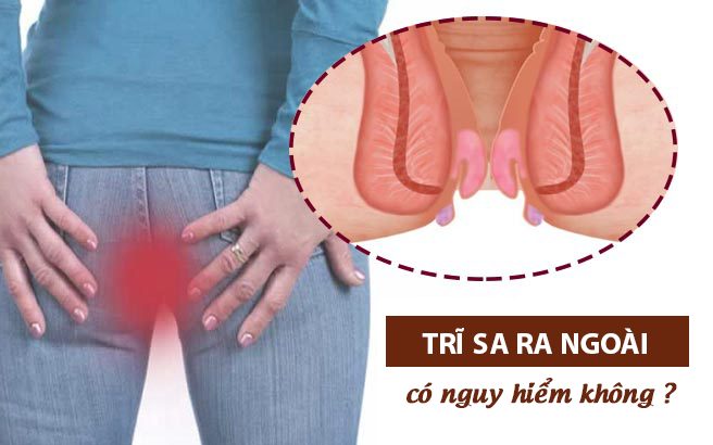 Sa búi trĩ có nguy hiểm không