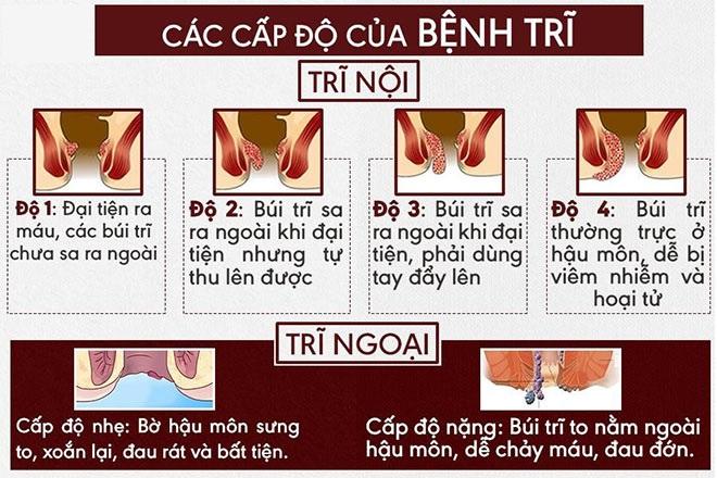 Các cấp độ của bệnh trĩ, búi trĩ sa ra ngoài
